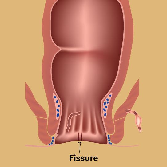 fissure treatment