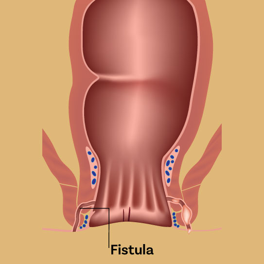 fistula treatment