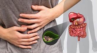 Gallstones Treatment