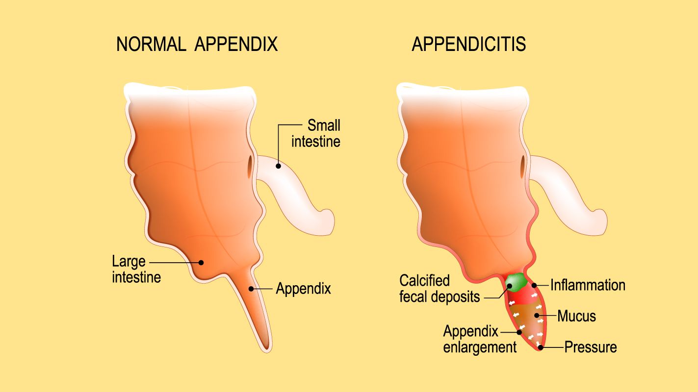Appendicitis