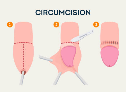 Laser Circumcision