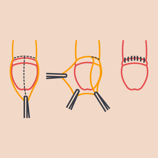 Stapler Circumcision