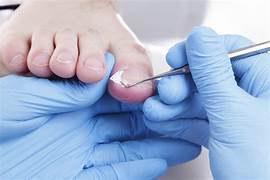 Toenail Removal