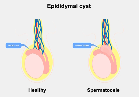 Epididymal cyst